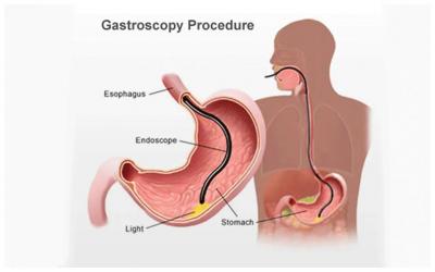 Gastroscopy Procedure | Gastroscopy Cost in Ahmedabad, Gujarat - Ahmedabad Health, Personal Trainer