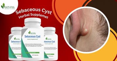 Useful Herbal Supplement for Sebaceous Cyst Natural Recovery - Chennai Health, Personal Trainer