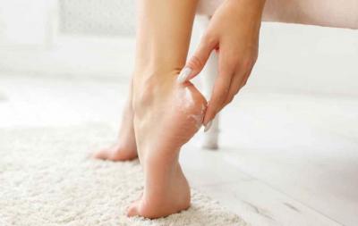 Homeopathic Medicine for Cracked Heels - Delhi Other