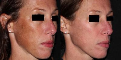 skin tightening treatment abudhabi | morpheus rf | scarlet rf  - Abu Dhabi Other
