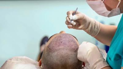 Best Doctor for Hair transplant Clinic in Faridabad- Revyve Care - Faridabad Health, Personal Trainer