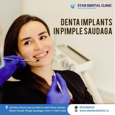 Dental Implants Specialist in Pimple Saudagar | Star Dental Clinic 