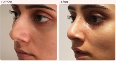Best Rhinoplasty Surgeon in India - Expertise by Dr. Vivek Kumar