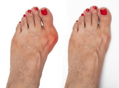 Discover Expert Bunion Surgery in London!