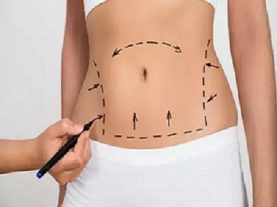 Liposuction Surgeon Downey - Other Other