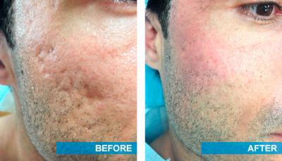 Best Acne Scars Treatment in Delhi NCR