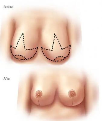 Affordable Breast Reduction Surgery in Delhi