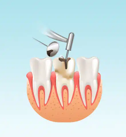 Preserving Smiles: Expert Root Canal Treatment in navi mumbai at Smile Avenue Clinic 
