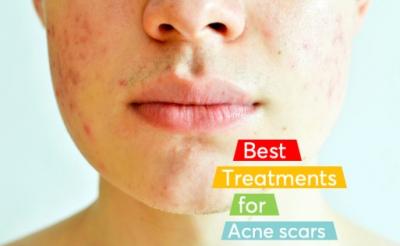 Best Acne Scar Treatment in Gurgaon