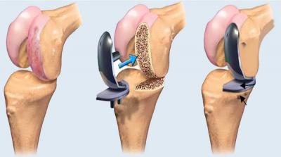 Knee Arthroscopy Doctor  in Noida  – Knee Arthroscopy - Delhi Other