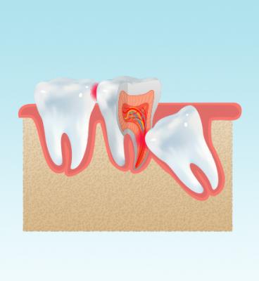 Expert Wisdom Tooth Extraction in Nerul: Your Solution to Dental Comfort