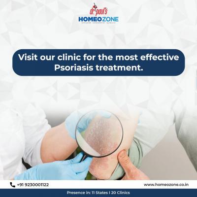 Discover Freedom from Psoriasis with Homeozone's Homeopathy Treatment in Kolkata