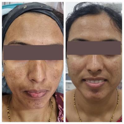 Melasma Treatment in Pune, Pimpri Chinchwad |Melasma Treatment in Hinjewadi - Pune Health, Personal Trainer