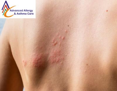 Reliable Treatment of Hives Desensitization - Other Health, Personal Trainer