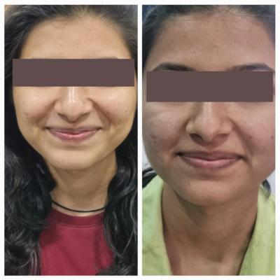 Skin Polishing Treatment in Pune, Pimpri Chinchwad | Skin Polishing Treatment Hinjewadi - Pune Health, Personal Trainer