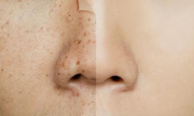 Skin Pigmentation Treatment in Pune - Other Other