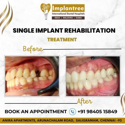Best Dental Implant Clinic in Saligramam
