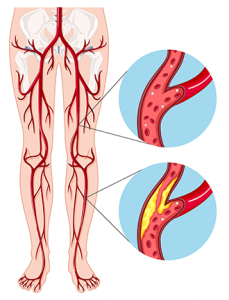Types of Vascular Conditions | Vascular Disease & Artery Disease Center - Jaipur Health, Personal Trainer