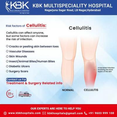 Cellulitis Treatment in Hyderabad - Hyderabad Health, Personal Trainer