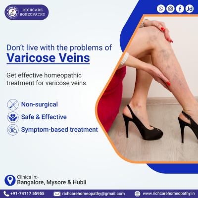 Varicose Veins Homeopathy Treatments in Bangalore 