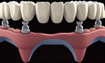 Dental Bridge Front Teeth | Platinum Dental Care - Other Health, Personal Trainer