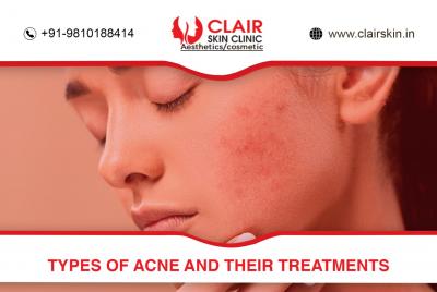 Types of Acne and Their Treatments | Clair Skin Clinic - Delhi Health, Personal Trainer