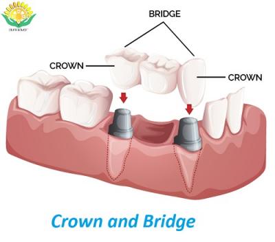 Crown and Bridge Works from China
