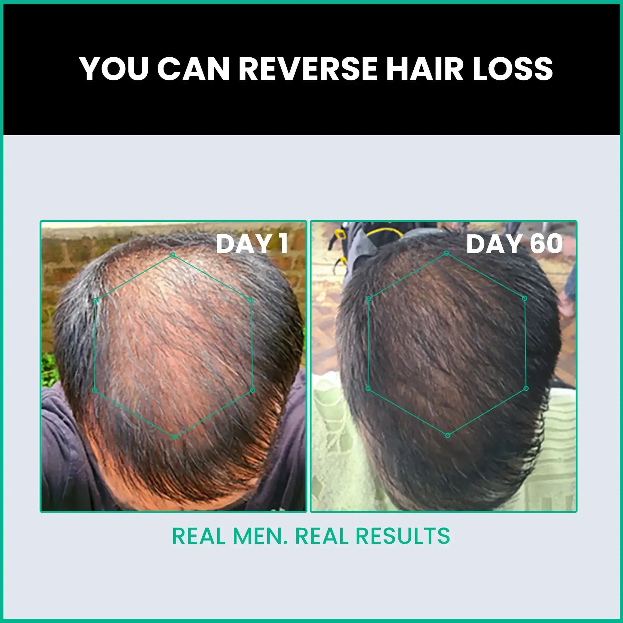 Regrow Your Hair in 60 Days with Hair Growth Serum - Gurgaon Other