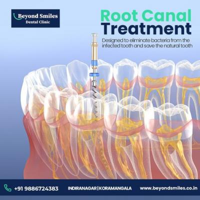 Root Canal Treatment in Bangalore - Bangalore Health, Personal Trainer