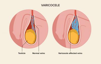 How Diet Can Impact Varicocele: A Comprehensive Guide - FlowCare - Jaipur Health, Personal Trainer