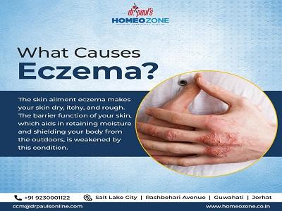 Holistic Healing: Discover Effective Eczema Treatment in Kolkata with Homeozone
