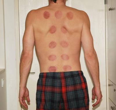 Cupping Therapy Gives Wellness in Milton, Ontario