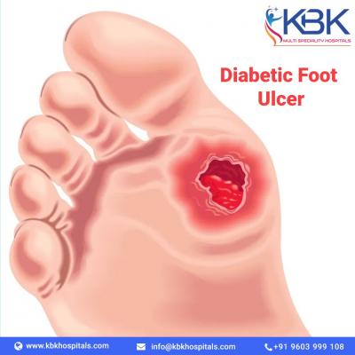 Diabetic Foot Clinic in Hyderabad - Hyderabad Health, Personal Trainer