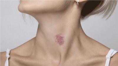Removing a Hickey with Toothpaste: Debunking a Myth - New York Other