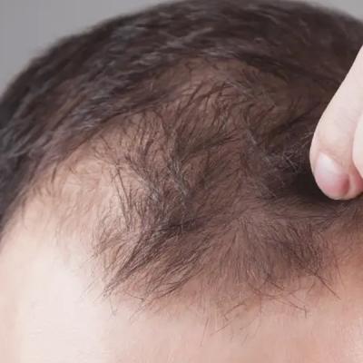 Regain Your Confidence with Hair Transplant Treatment in South Bay - Get a Free Consultation - Other Other