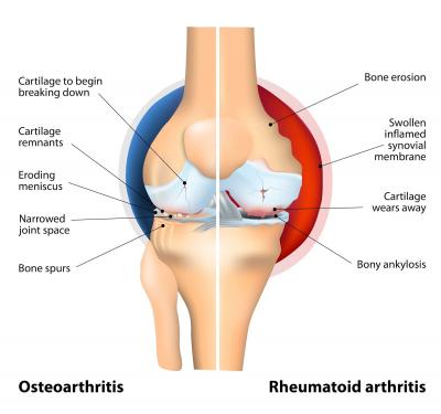 Arthritis Treatment In Pune - Other Other