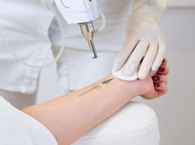 Discover Expert Laser Tattoo Removal in Dubai