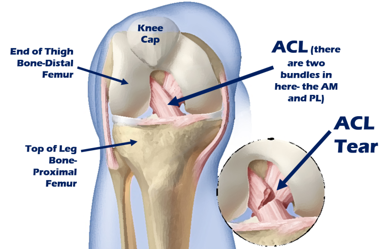 ACL Reconstruction Surgery Restoring Stability and Mobility | Verddaan Hospital