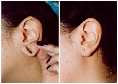 Ear lobe repair Treatment in Pune - Other Health, Personal Trainer