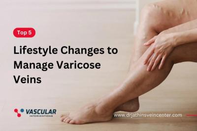 Healthy Living, Happy Legs: Mastering Varicose Vein Management with 5 Lifestyle Changes - Mumbai Health, Personal Trainer