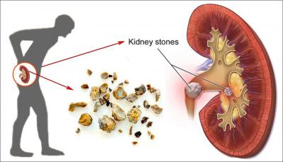 Kidney Stone Treatment In Pune - Other Other