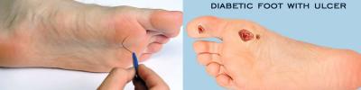 Diabetic Insoles Treatment | Boynerclinic.com - Delhi Health, Personal Trainer