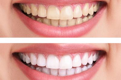 Teeth Whitening Gel – BEDC