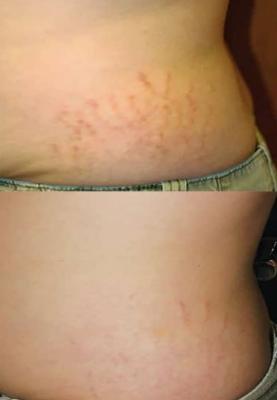 Stretch Mark Reduction Treatment in Pune - Other Other