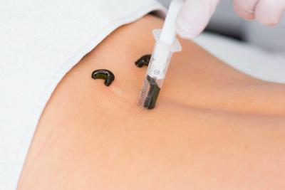 Top Leech Therapy in Ghaziabad. - Ghaziabad Other