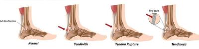 Achilles Tendon Burning Pain Treatment | Boynerclinic.com