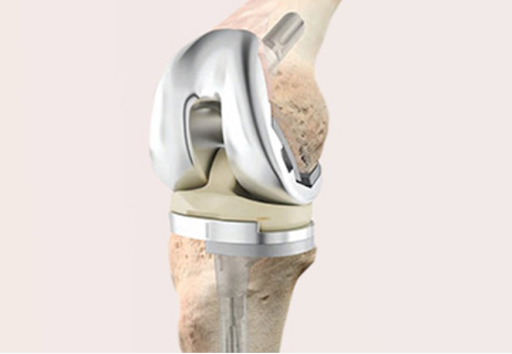Revision Joint Replacement Surgery in Indore - Dr. Vinay Tantuway - Indore Health, Personal Trainer