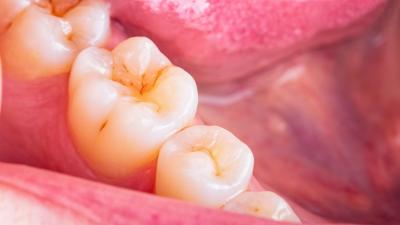 Decoding Dental Decay: What Cavities Look Like