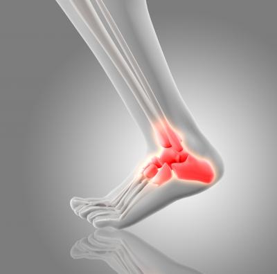 Calcaneal Spur | Boynerclinic.com