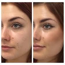 Specialised Chemical Skin Peels in North East Area